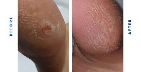 Cryotherapy Verrucae treatment