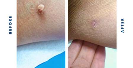 Cryotherapy Deep Dive Skin Tag