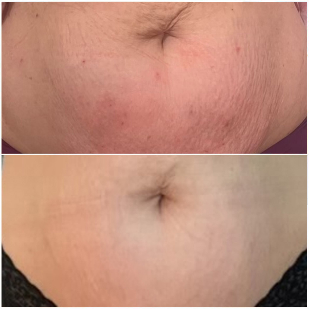 Carboxy Skin Tightening
