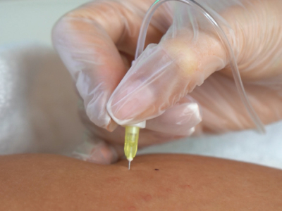 Fat Reduction Treatment