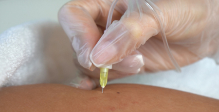 Fat Reduction Treatment