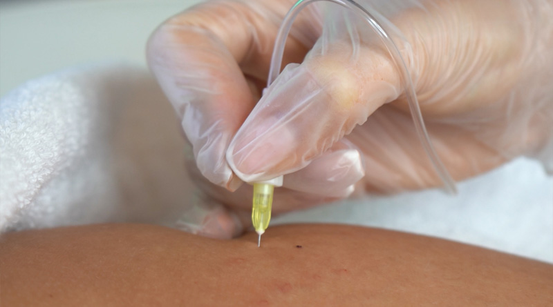 Fat Reduction Treatment