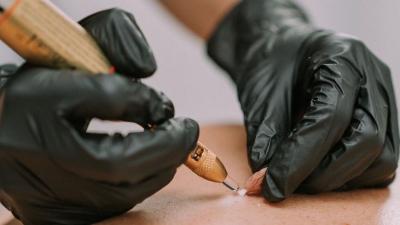 Cryotherapy vs. Electrolysis - Blog Banner