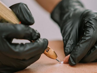 Cryotherapy vs. Electrolysis - Blog Banner