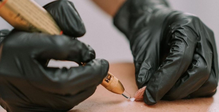Cryotherapy vs. Electrolysis - Blog Banner