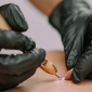 Cryotherapy vs. Electrolysis - Blog Banner